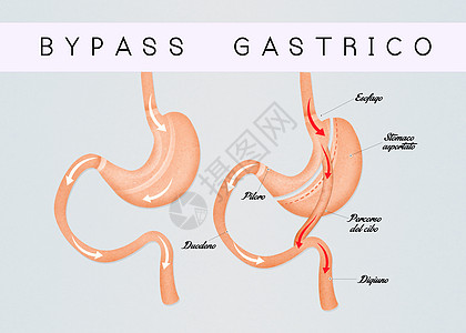 肠胃绕行方案器官插图饮食外科减肥肥胖保健肠子手术图片