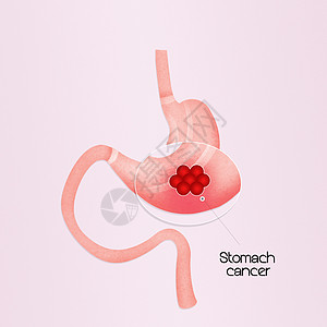 胃癌胃炎冒号癌症外科医疗粘膜手术放射科器官插图背景图片