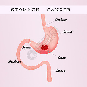 胃癌外科溃疡方案癌症插图冒号考试药品器官放射科图片