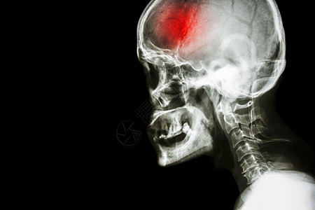 胶片X射线头骨和宫颈脊椎横向视图和中风 脑血管事故 左侧空白区颅骨攻击头痛扫描病人颈椎病脖子x射线脊柱x光图片