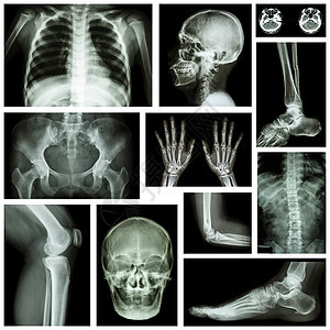 人体骨骼系统的一组X射线多重部分放射科医生x射线药品器官膝盖脊柱卫生弯头男人图片