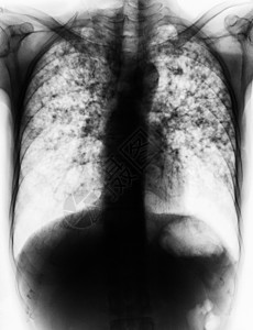 肺部肺结核肋骨疾病男人身体结核肺炎纤维化x射线科学放射科图片