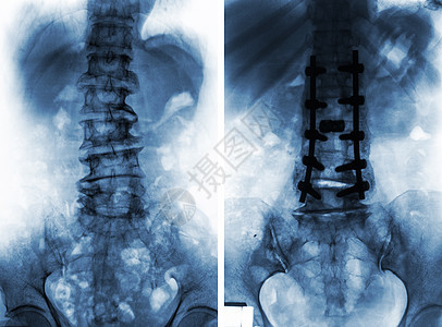 外科手术前后的脊柱性硬化症射线脊椎放射科x射线脊柱金属疾病腰椎身体治疗图片