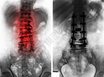 Spondylsis 手术前后图片