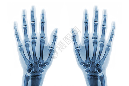 X光片两只手都用白色背景显示正常人手孤立放射科数字病人电影风湿诊断x光医院前臂棕榈图片