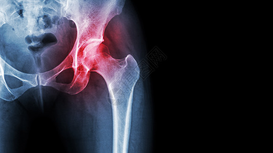 抖腿髋关节关节炎 X 光片显示右侧髋关节和空白区域发炎 缺血性坏死概念药品风湿关节炎外科疾病蓝色手术痛风扭伤骨关节炎背景