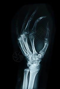 切骨骨 人类X雷保健创伤棕榈手腕诊断病人解剖学射线电影手指图片