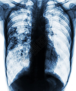 肺结核感染导致右肺渗透到右肺部的胸透片X光片片片段x光射线空腔肺炎身体细菌x射线男人胸部蓝色图片