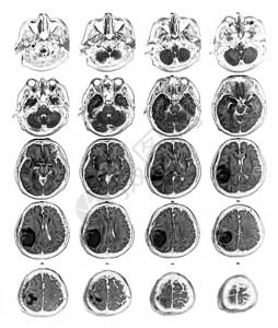 MRI脑部显示右皮骨叶上的脑瘤神经病x射线医院神经元中风颅骨电脑诊断大脑脑血管图片