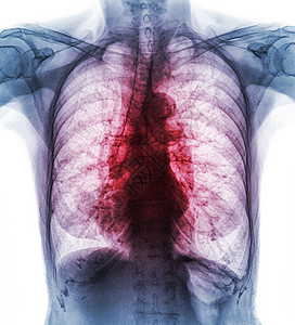 肺结核 由于结核分枝杆菌感染 电影胸部 X 光片显示间质浸润双肺药品放射科病人医院蓝色结核病感染射线身体男人图片