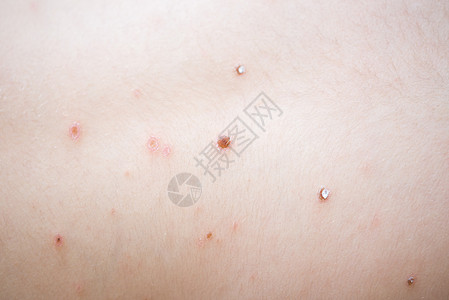 小孩身上长水痘过敏宏观躯干儿科麻疹颠簸传染性疱疹划痕皮肤图片