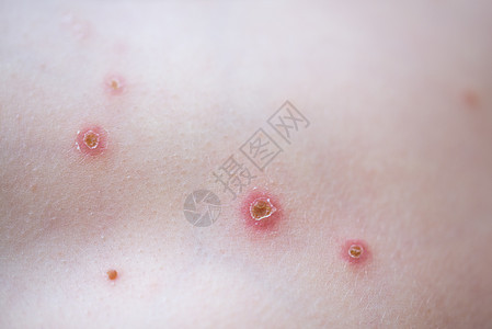 小孩身上长水痘粉刺躯干疾病疱疹感染孩子身体表皮麻疹发痒图片