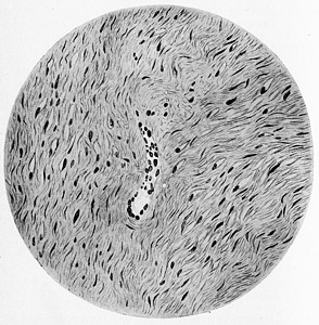 软纤维瘤 老式雕刻图片