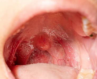 喉咙痛 喉咙肿胀 用后继剂闭合嘴张开卫生组织牙科口咽卵泡咽喉细胞宏观咳嗽疾病图片