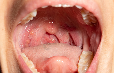 喉咙痛 喉咙肿胀 用后继剂闭合嘴张开血管病人药品流感口咽细胞咽喉卫生舌头上呼吸道图片