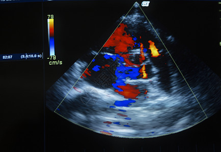 电脑屏幕上的心脏超声波图像照片考试扫描愈合心脏病考勤治疗技术科学诊所图片
