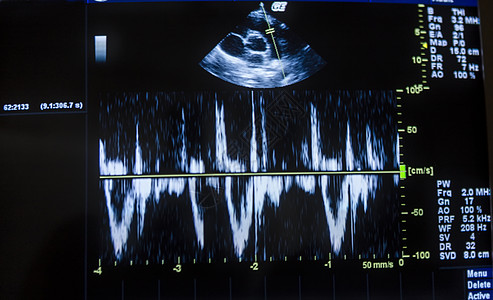 计算机屏幕和心电图上的心脏超声波图像图片
