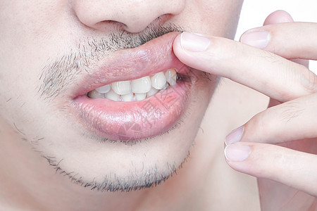 男人嘴唇上下加整容手术 美貌皮肤塑料切口男性尺寸药品雕刻程序不对称注射器图片