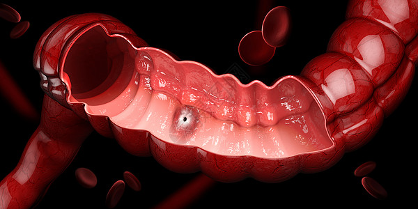 胃溃疡 3D 说明人类胃解剖图片