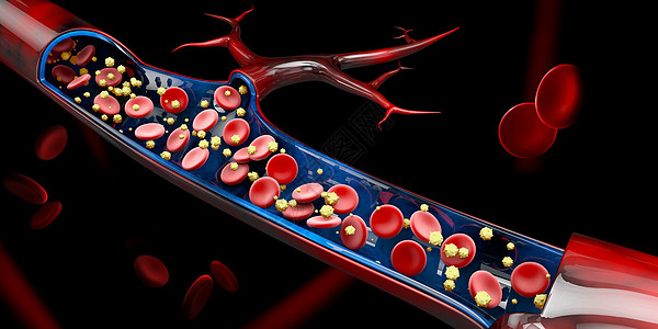 静脉溶栓3d 血液血管中的钙含量说明心血管动脉疾病中风红细胞毛细管静脉血栓生物药品背景