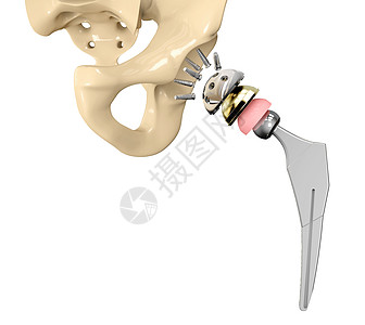 3D 插在骨盆骨上安装的替换胸膜植入图假肢腰带软骨骨科药品关节骨骼创新解剖学髋臼图片