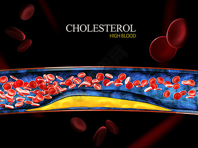 3D立体地贴3d 用凝固胆固醇的立体积块显示血细胞外科凝块疾病积累保健硬化攻击血管血栓科学背景