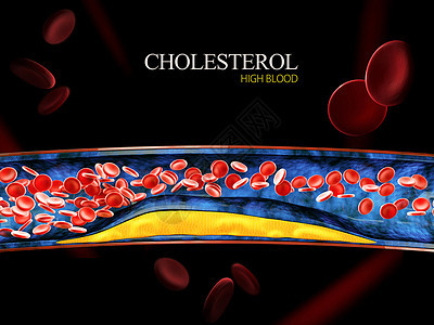 3d 用凝固胆固醇的立体积块显示血细胞外科凝块疾病积累保健硬化攻击血管血栓科学图片