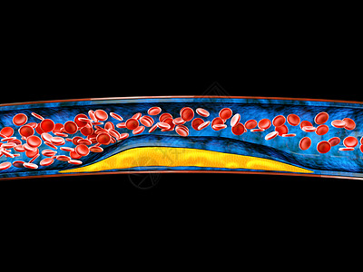 3D立体地贴3d 用凝固胆固醇的立体积块显示血细胞保健动脉封锁硬化动脉粥样硬化积累静脉风险科学外科背景