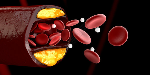 3d 显示血细胞与凝固胆固醇隔离黑的立体积聚外科手术危险硬化动脉粥样硬化动脉身体疾病药品静脉背景图片