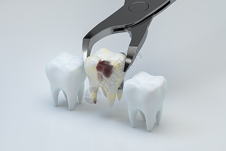 病齿被拔出 3D转化图片