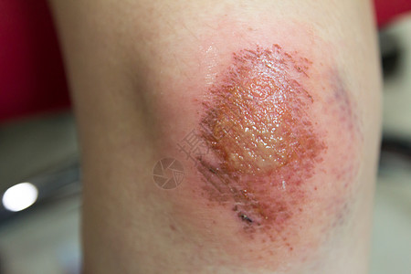 包扎伤口新的伤口 淋巴和鲜血印在亚裔女性膝盖底部医院伤害女士疼痛皮肤创伤药品感染事故保健背景