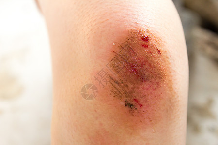 妇女膝盖背景伤伤 伤伤伤伤害组织保健肌肉工作皮肤运动划痕赔偿运动员图片