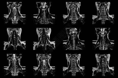 C6-C7区段的双准中间介质外溢 以及放射细胞病原体 对白鲸男性颈部区域进行一套冠状核磁共振动扫描图片