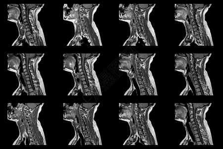 C6C7区段的双准中间介质外溢 并进行放射细胞病理学检查 对大肠男性颈部区域进行一套射成像性磁RI扫描疼痛压缩椎骨照相卫生放射科图片