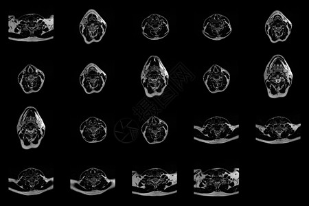 在C6-C7区段的双准中间介质外溢 并进行放射细胞病理学检查时 对caucasian 男性颈部区域进行一套横向MRI扫描图片