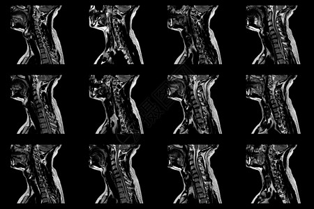 C6C7区段的双准中间介质外溢 并进行放射细胞病理学检查 对大肠男性颈部区域进行一套射成像性磁RI扫描技术保健飞机谐振椎骨疾病x图片