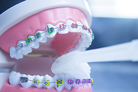 带有金属矫形剂的模型假牙牙科医疗医生白色健康矫正支撑示范诊所卫生图片