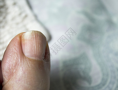 带真菌的脚趾甲医疗白色医生菌类赤脚疼痛疾病身体指甲变形图片