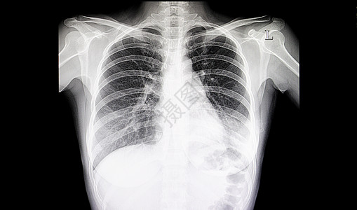 肺炎胸胸片图片
