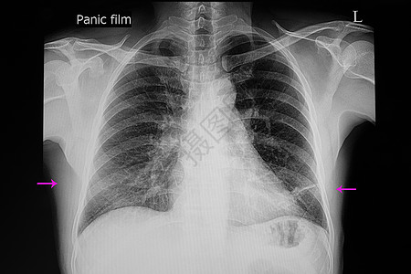 右下部肺肺肺炎图片