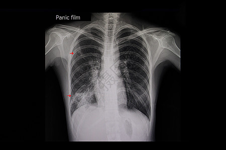 肺结核考试x光感染身体射线渗透医院解剖学胸部病人图片