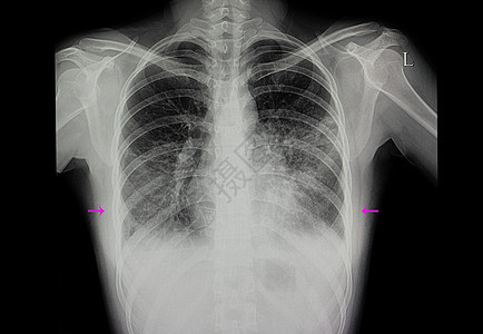 患有肺肺炎和肺部肺炎的病人图片