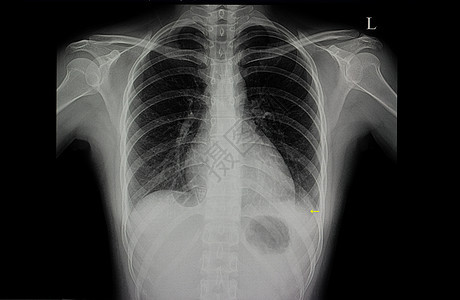 左下肺肺炎图片