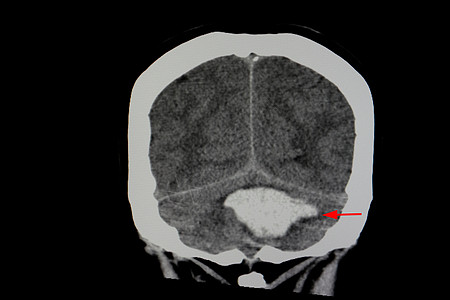 CT 脑扫瞄病人骨骼中风情况颅骨脑桥出血电影外科身体手术图片