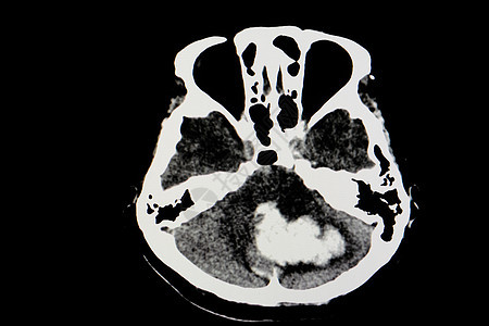 CT 脑扫瞄病人手术解剖学疾病神经身体射线断层外科骨骼医生图片