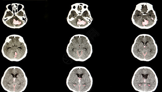 大规模出血性中风图片