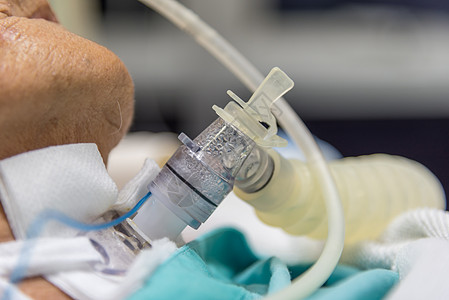 病人在医院做气管切除术和呼吸器诊所通风疾病实验室职业呼吸药品服务手术气管图片