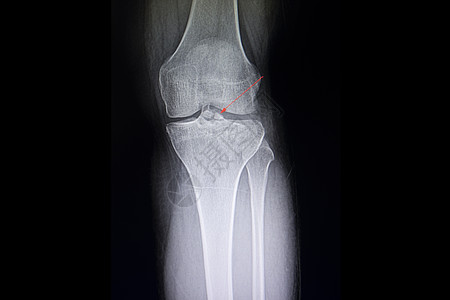 脊椎骨折质结柱膜临床骨科膝盖电影腓骨脊柱治疗胫骨药品末端图片