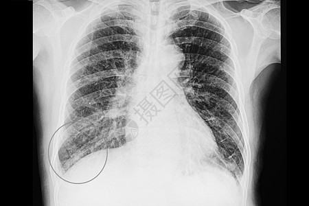 一名病毒性肺炎患者的胸透视图片