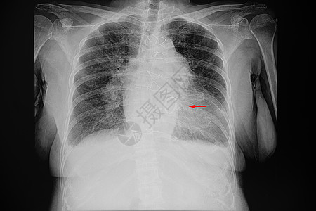 一名心血管病人的胸部X光片图片
